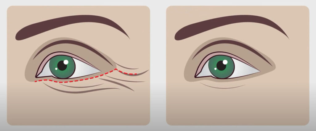 การผ่าตัดถุงใต้ตาแบบแผลนอก