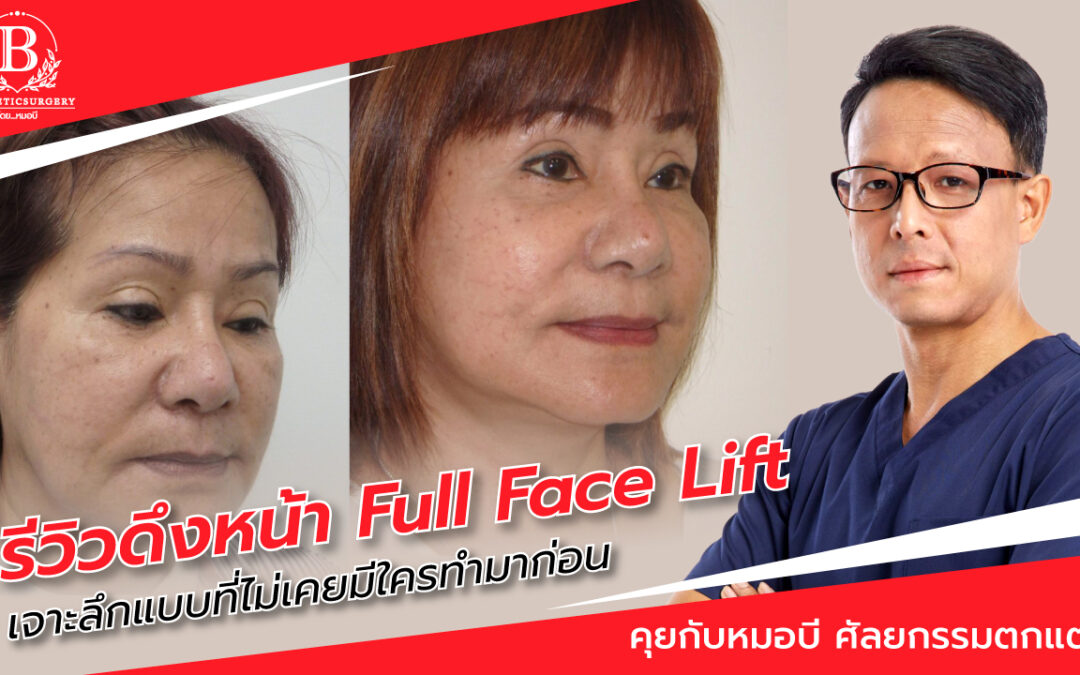 รีวิวดึงหน้า Full Face Lift คนไข้ผู้หญิงอายุ 57 ปี