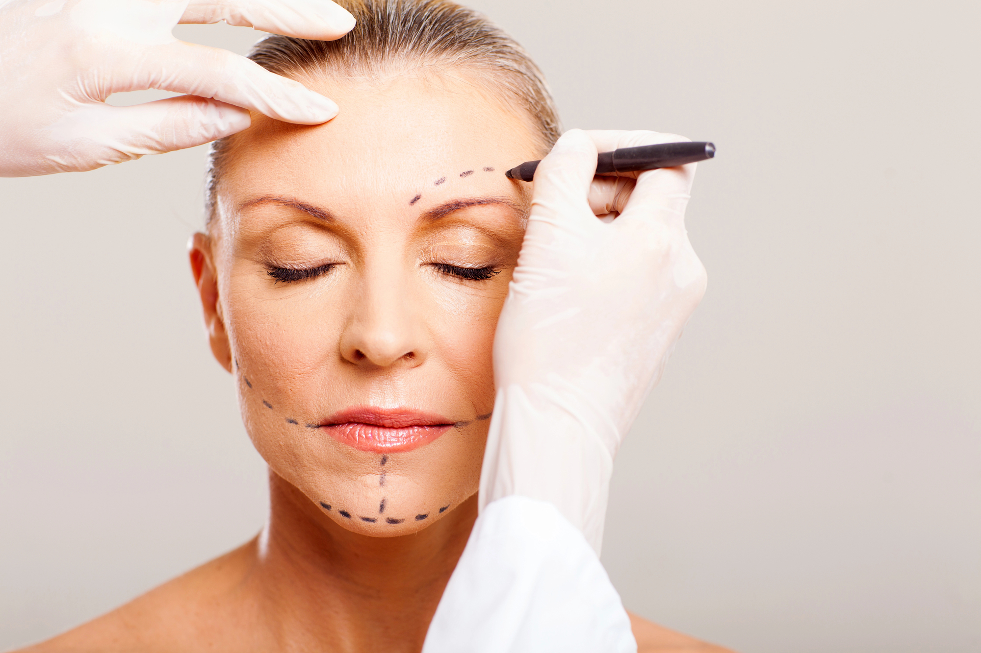 การผ่าตัดดึงหน้า (Face Lift)