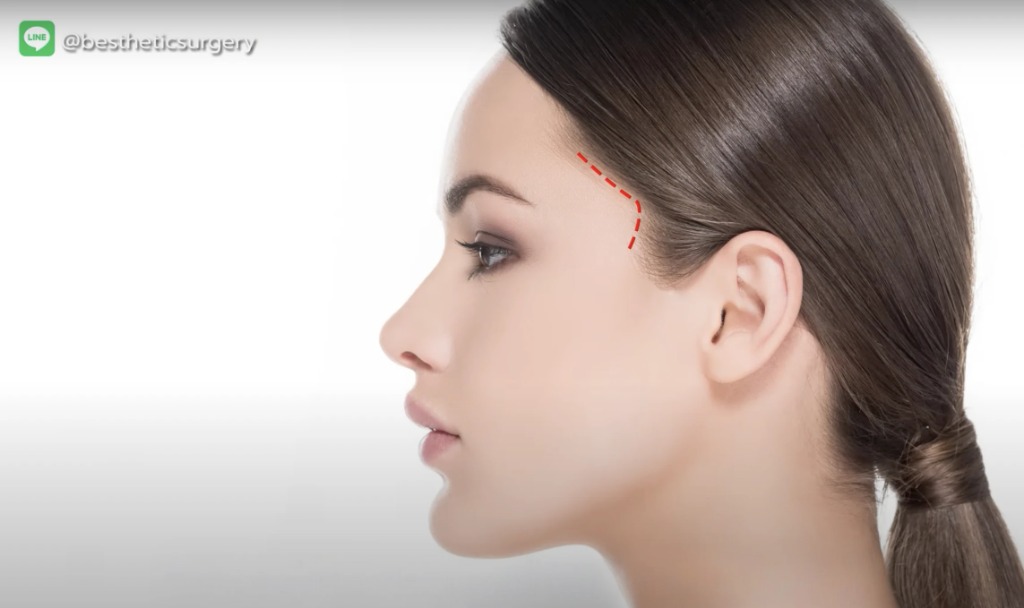 ดึงคิ้ว Lateral Brow Lift
