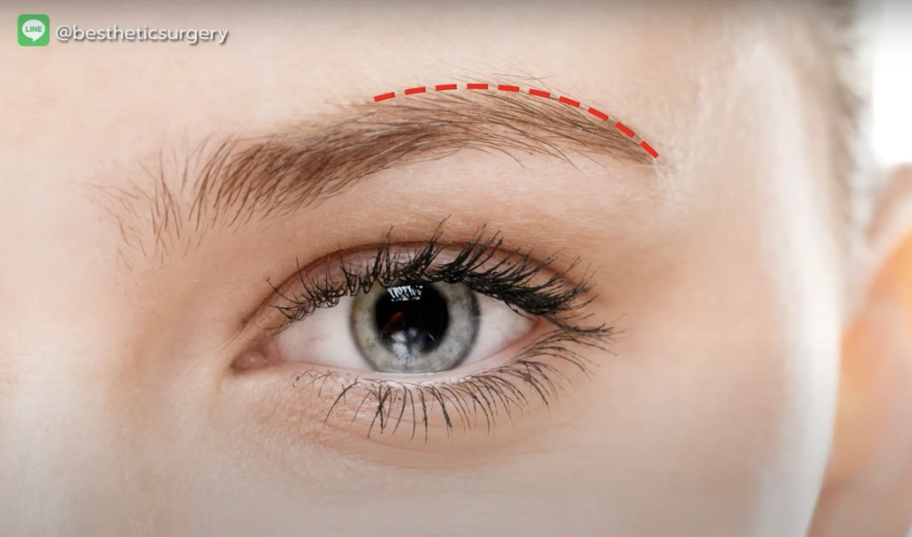 ดึงคิ้ว Direct Brow Lift