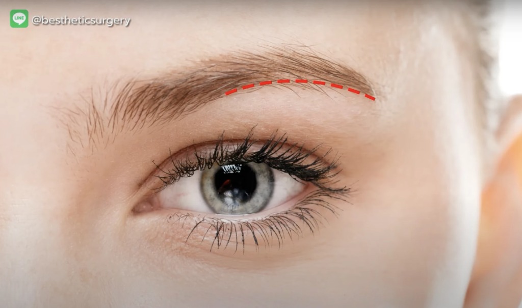 ดึงคิ้ว Sub Brow Lift